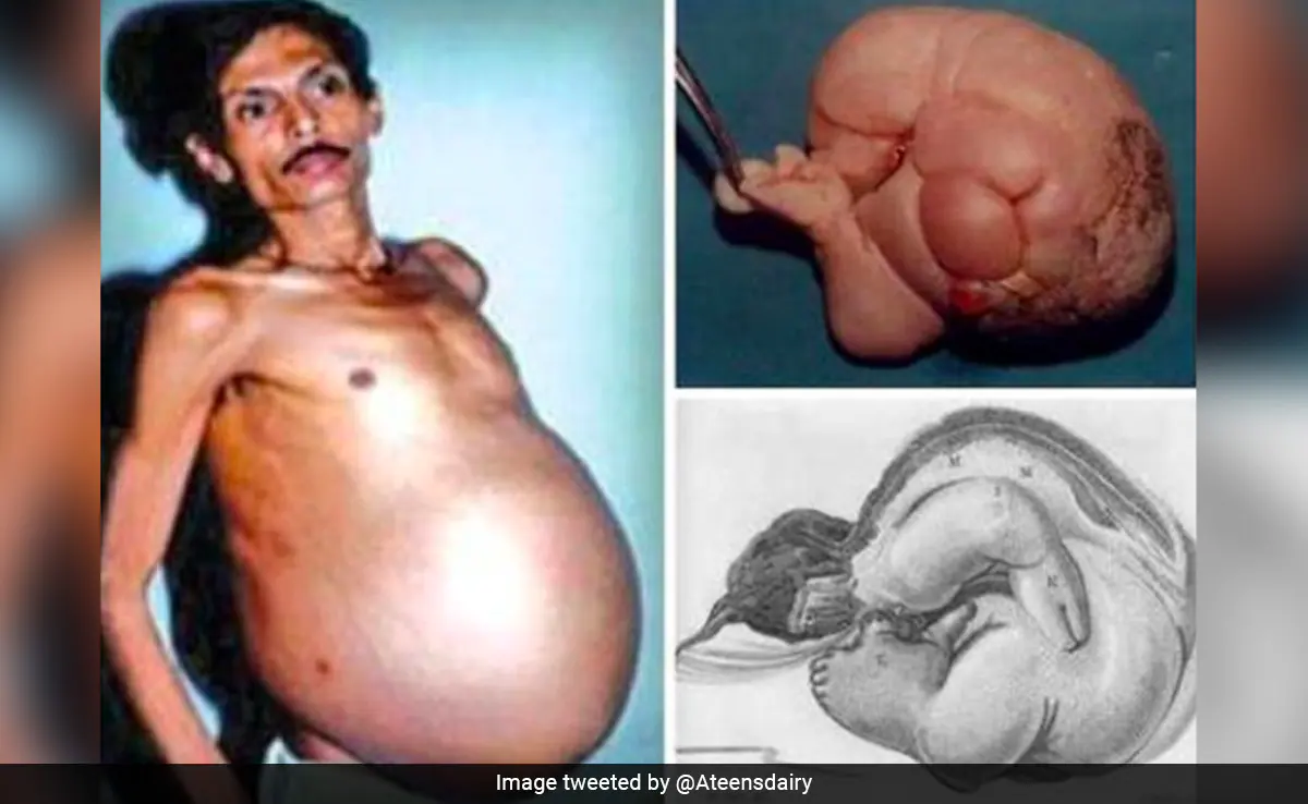 In Rare Medical Condition, Nagpur Man Was ‘Pregnant’ With Twin For 36 Years