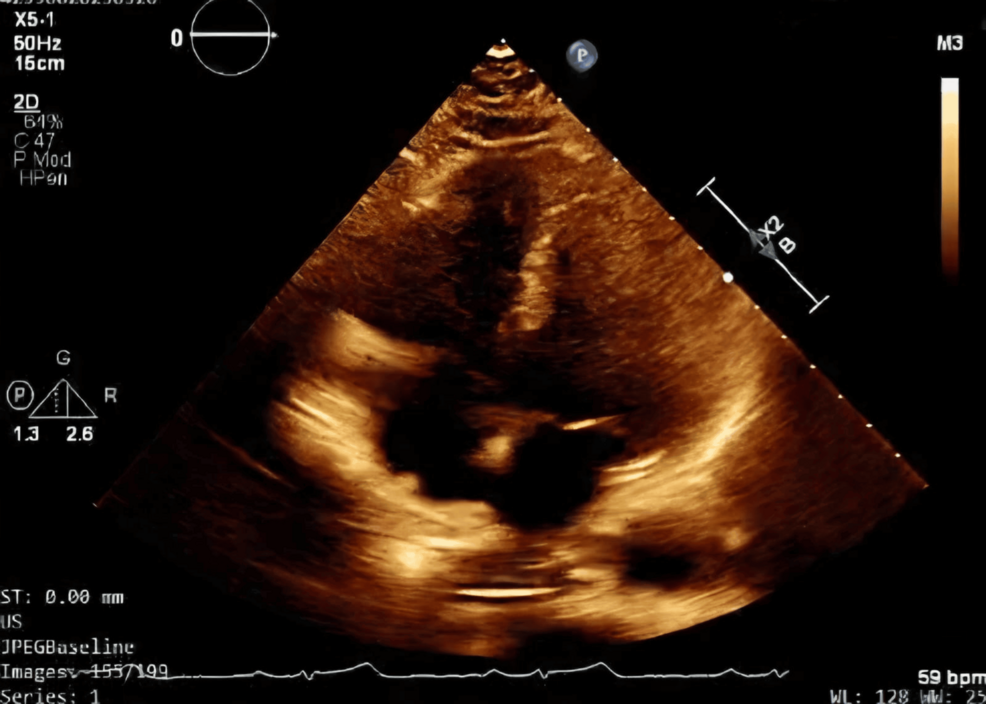 Routine Heart Scan Detects Advanced Liver Cancer in Rare Medical Case | Baaghi TV 