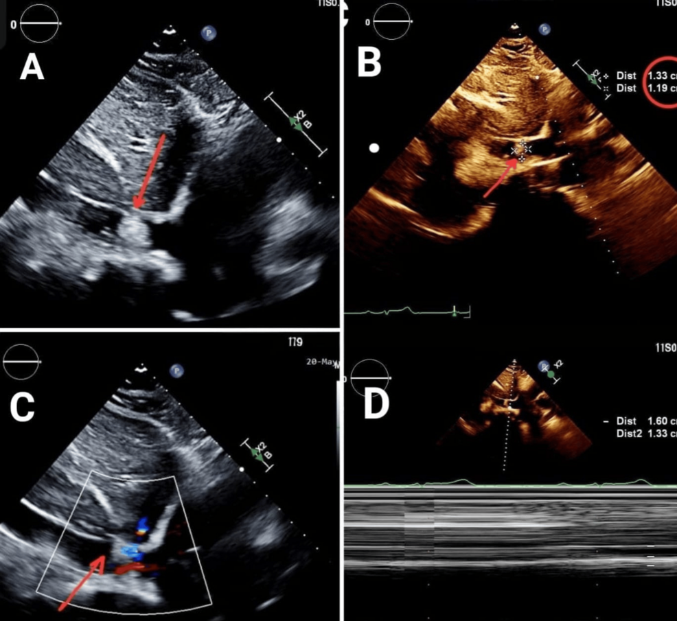 Routine Heart Scan Detects Advanced Liver Cancer in Rare Medical Case | Baaghi TV 