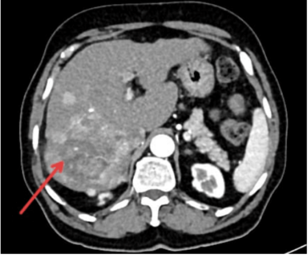 Routine Heart Scan Detects Advanced Liver Cancer in Rare Medical Case | Baaghi TV 