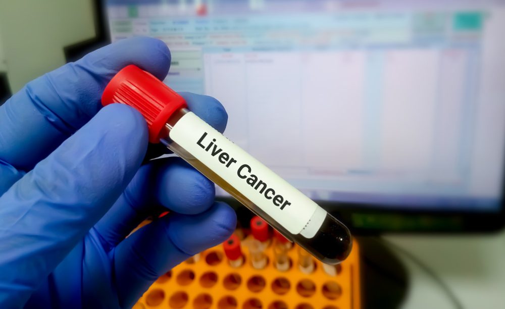 AI Blood Test Shows Promise for Early Liver Cancer Detection