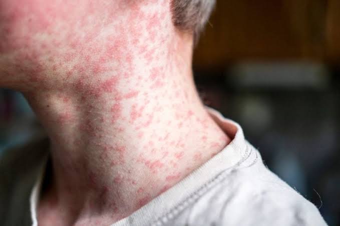 US | Measles Outbreak Spreads to Grant County, Wisconsin | Baaghi TV 
